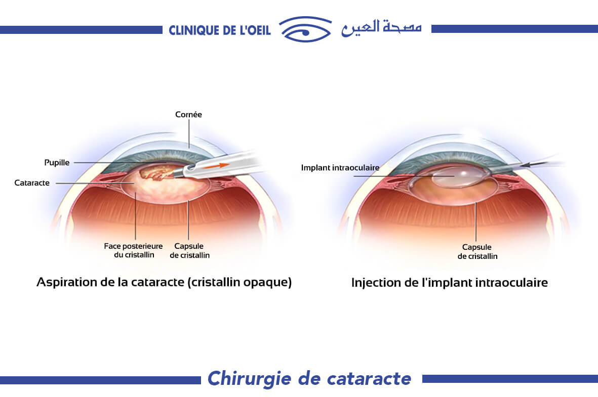 Chirurgie-de-cataracte